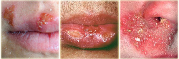 Photos of Cold Sores sufferers